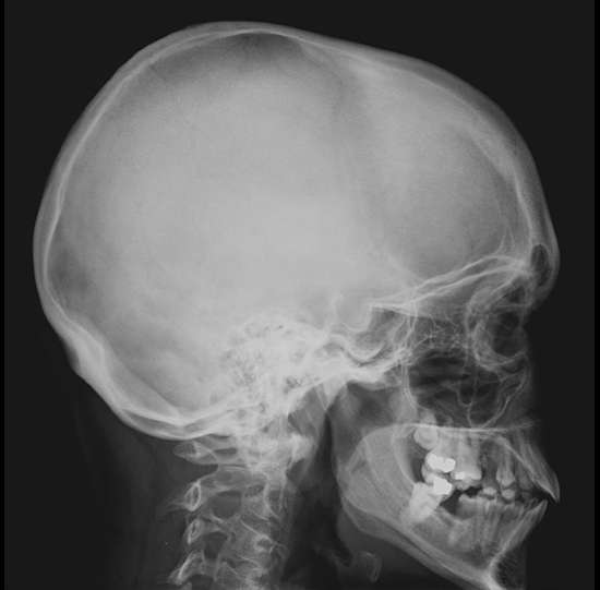 X-Ray Skull Lateral View, Preparation, Procedure, and the Requirements